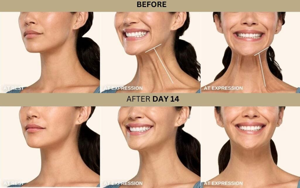 Botox Neck Band