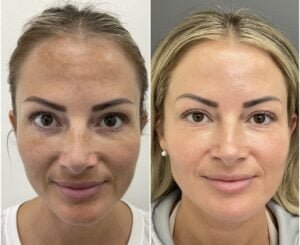 BBL and HALO for melasma1