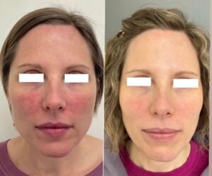 BBL Rosacea