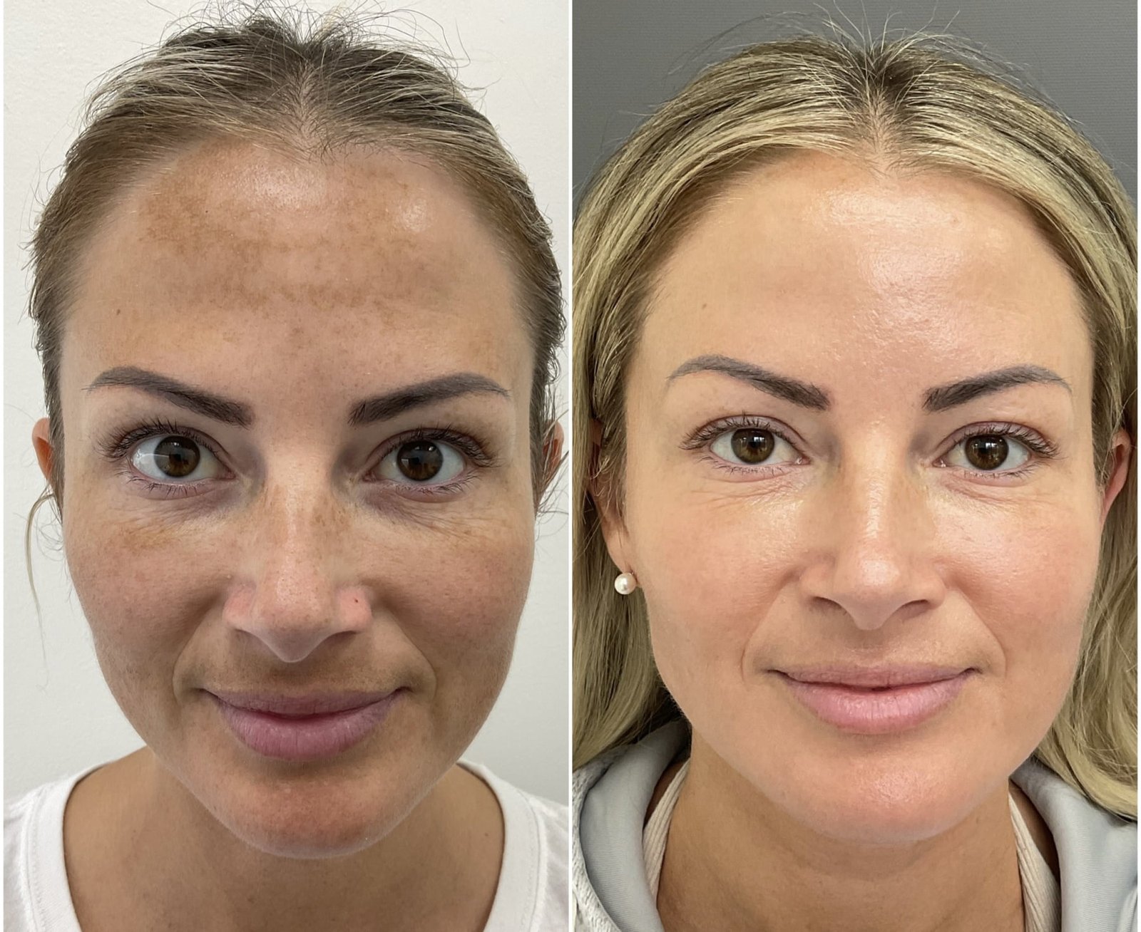 BBL and HALO for melasma1