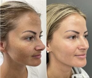 BBL and HALO for melasma2