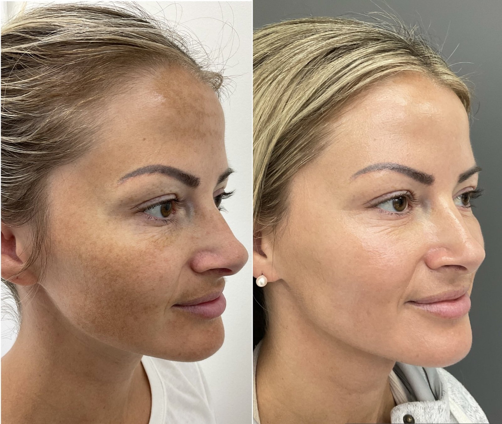 BBL and HALO for melasma2