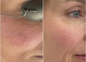BBL for rosacea