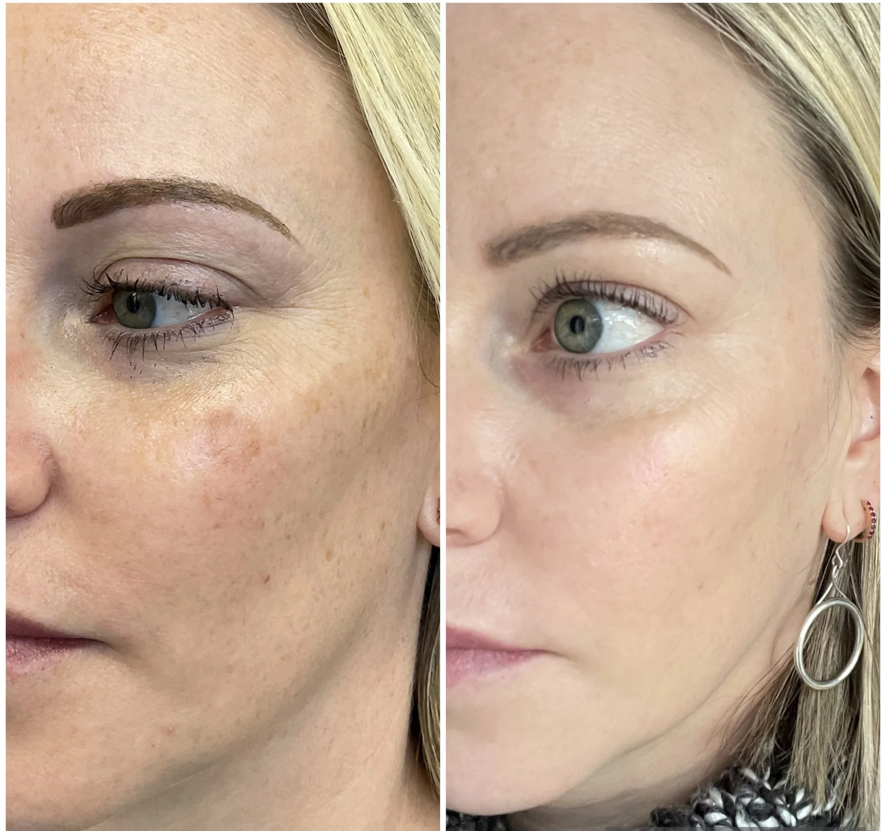 BBL page sun damage