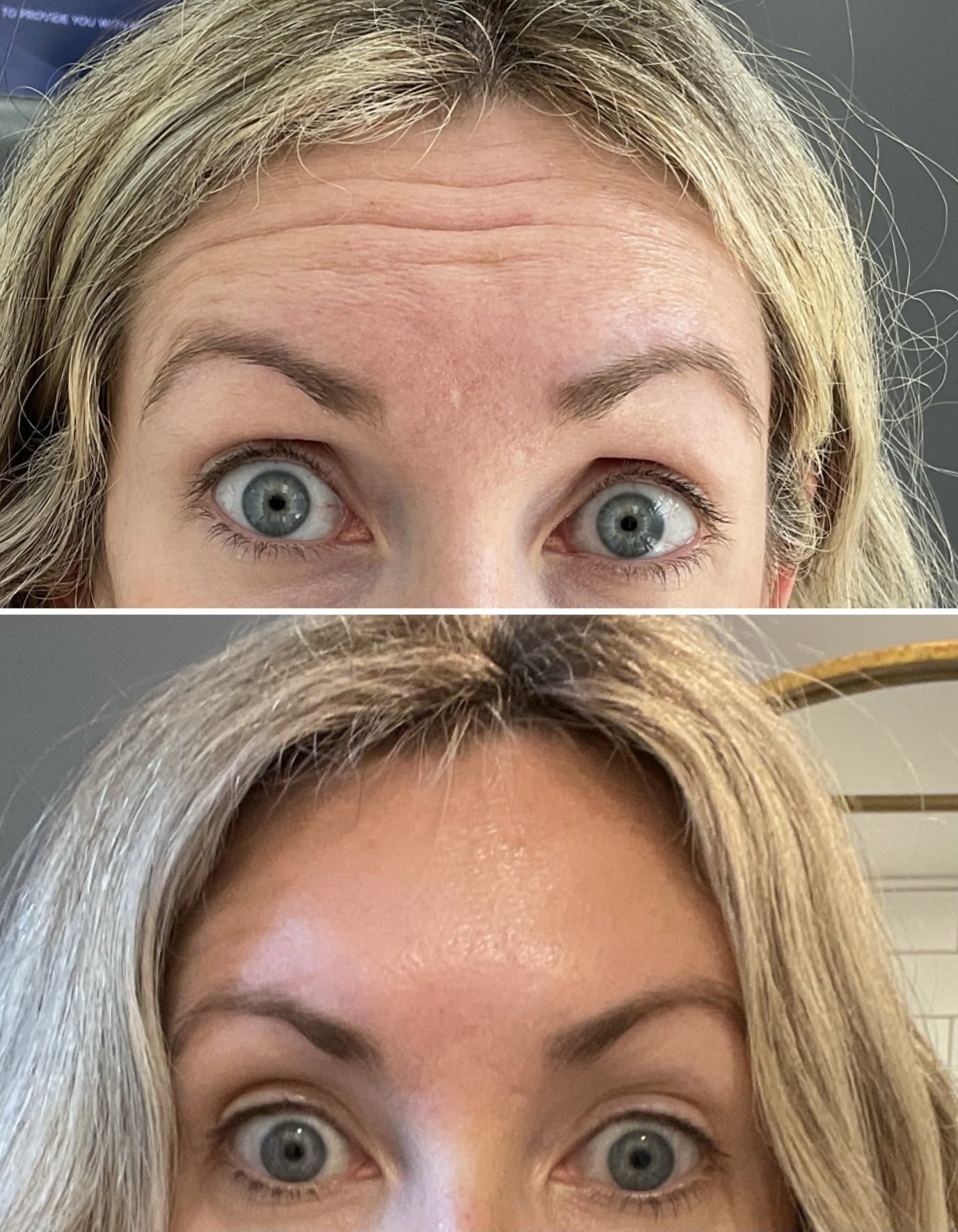 Botox forehead lines