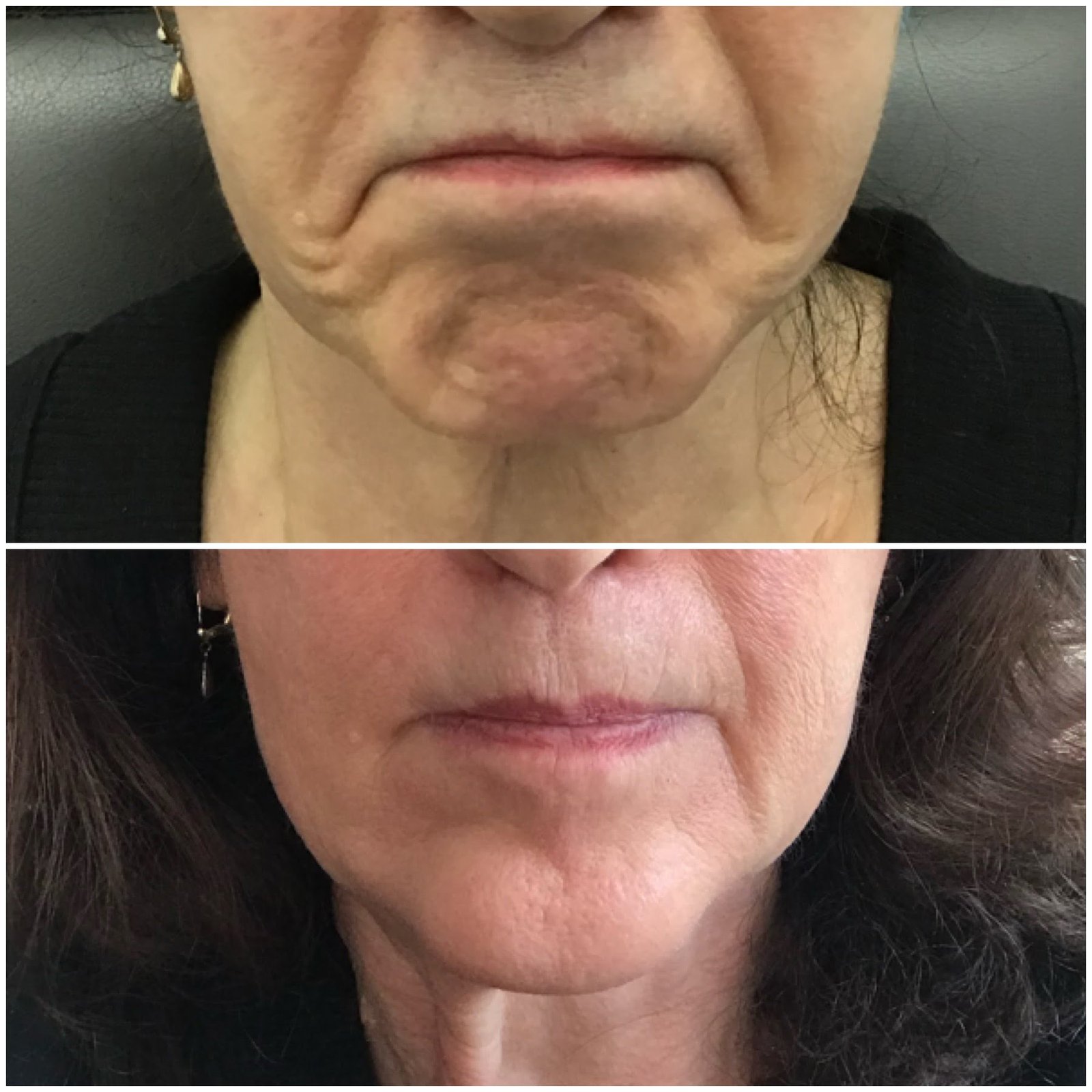 Botox jowls and chin