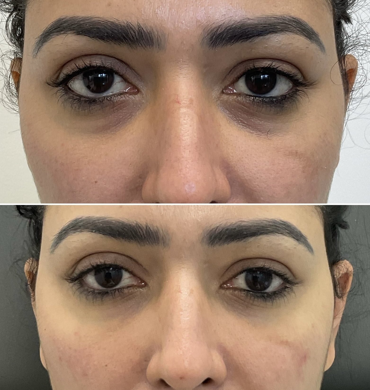 Filler for under eye dark circles