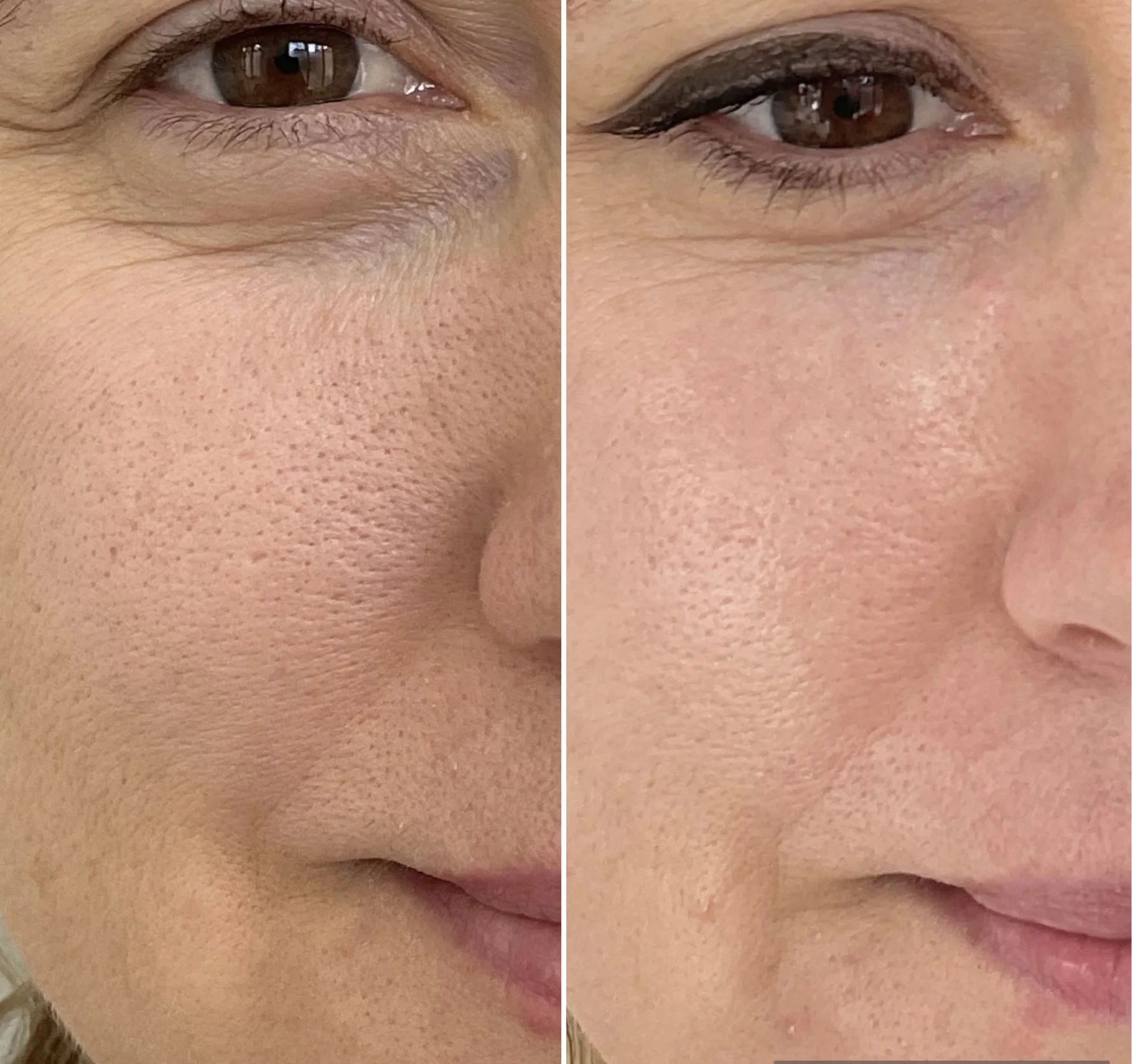 Halo for pores