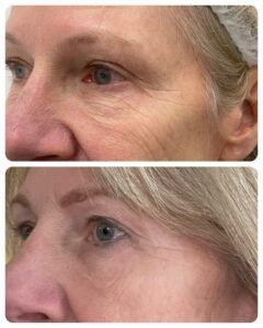 Laser resurfacing lower eye lids