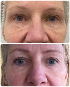 Laser resurfacing lower eyelids front