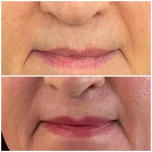 Laser resurfacing upper lip lines