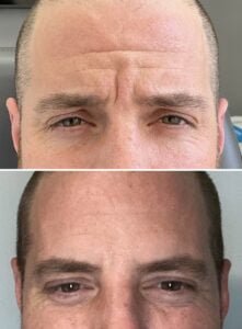 MENS botox for frown lines