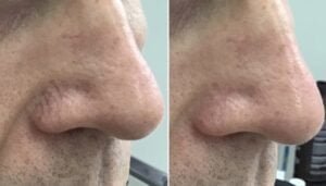 MENS page facial vessels on nose