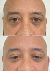 MENS page under eye filler