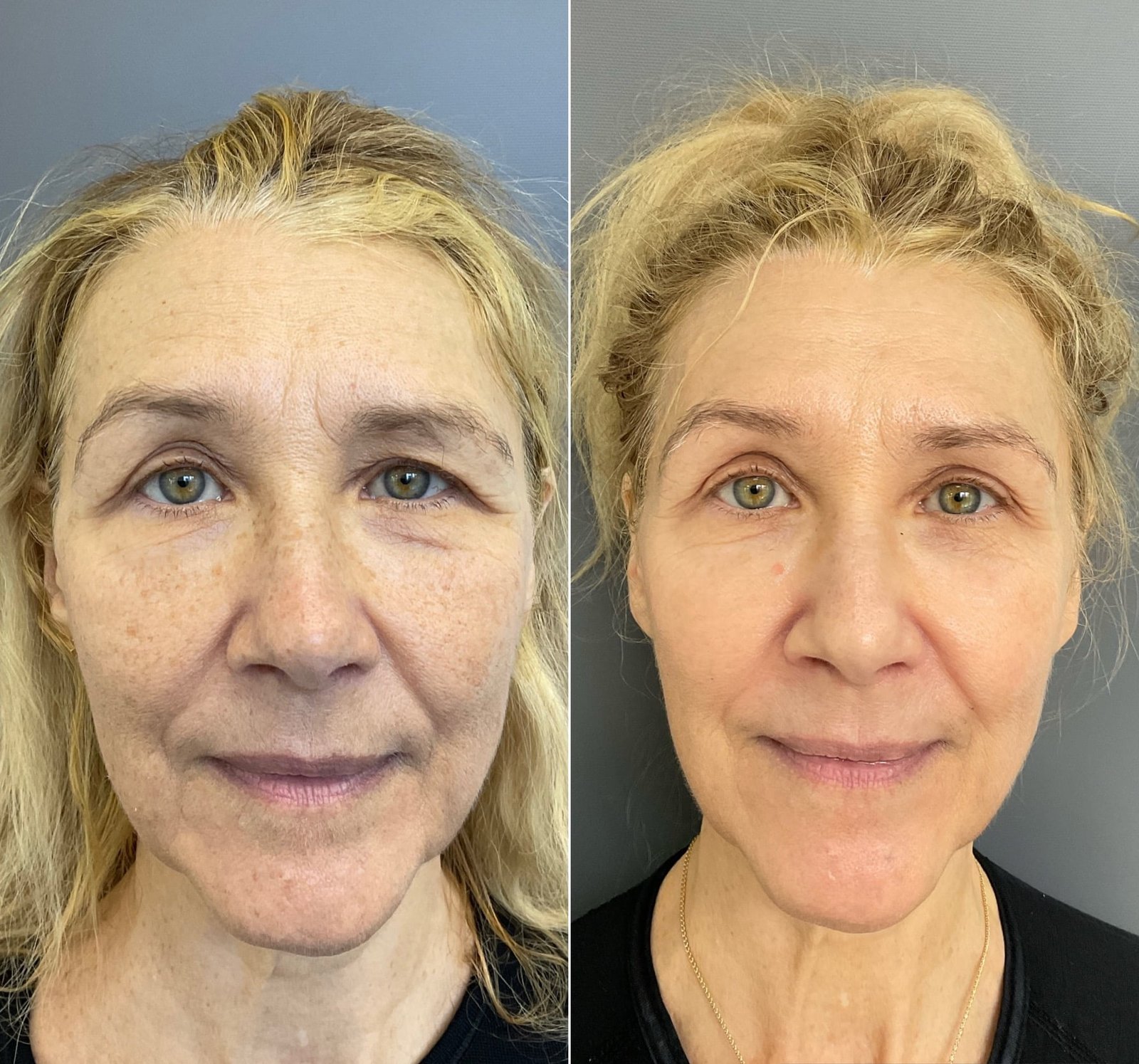 Before and After for HALO and BBL combination treatment