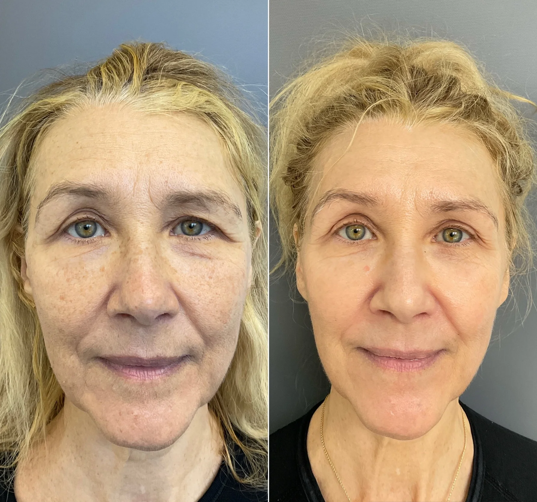 Before and After for HALO and BBL combination treatment