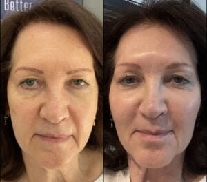 Fully Ablative Laser Resurfacing before and after