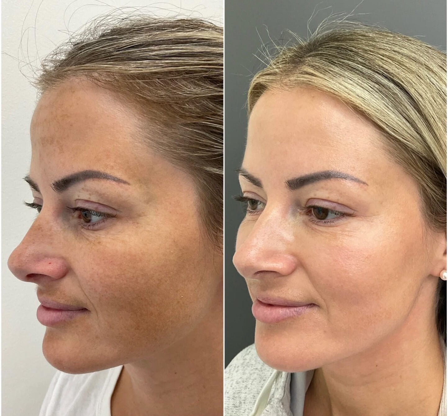 Before and After from a Sciton HALO treatment by Nurse Jacklyn