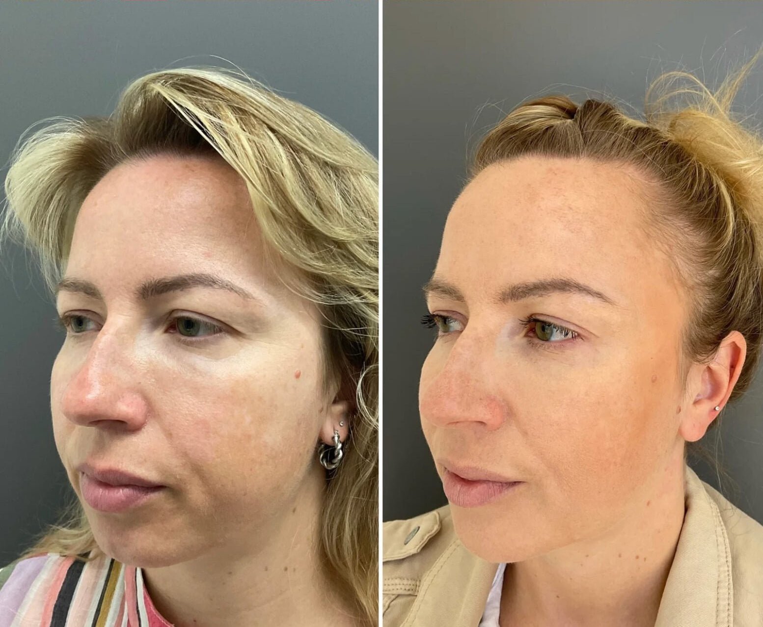 Filler for chin and jawline by Nurse Jacklyn before and after