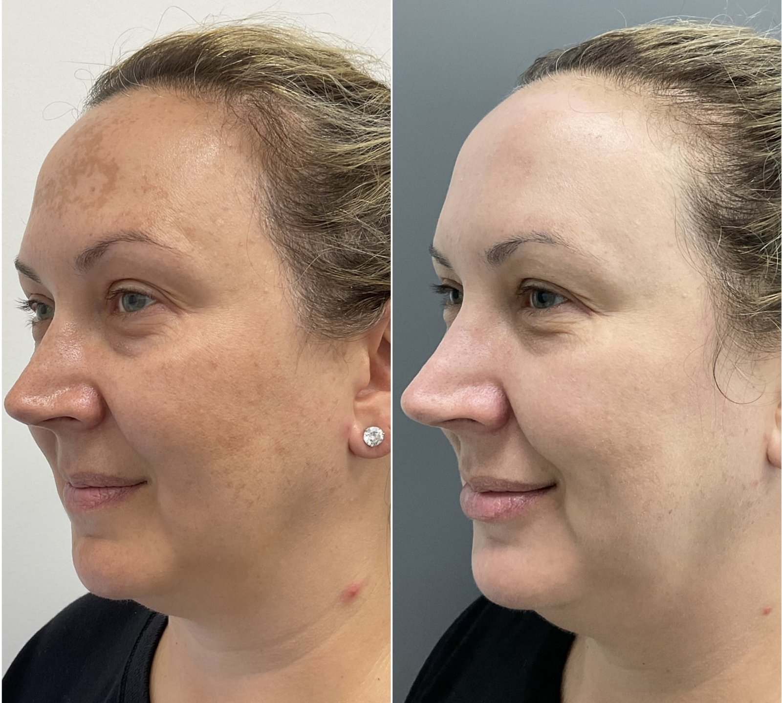 Before and After from a Sciton HALO treatment by Nurse Jacklyn
