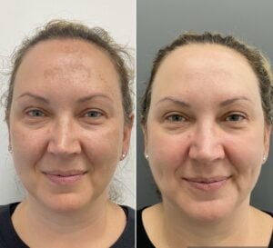 Before-and-after results from a Sciton HALO treatment by Nurse Jacklyn for melasma