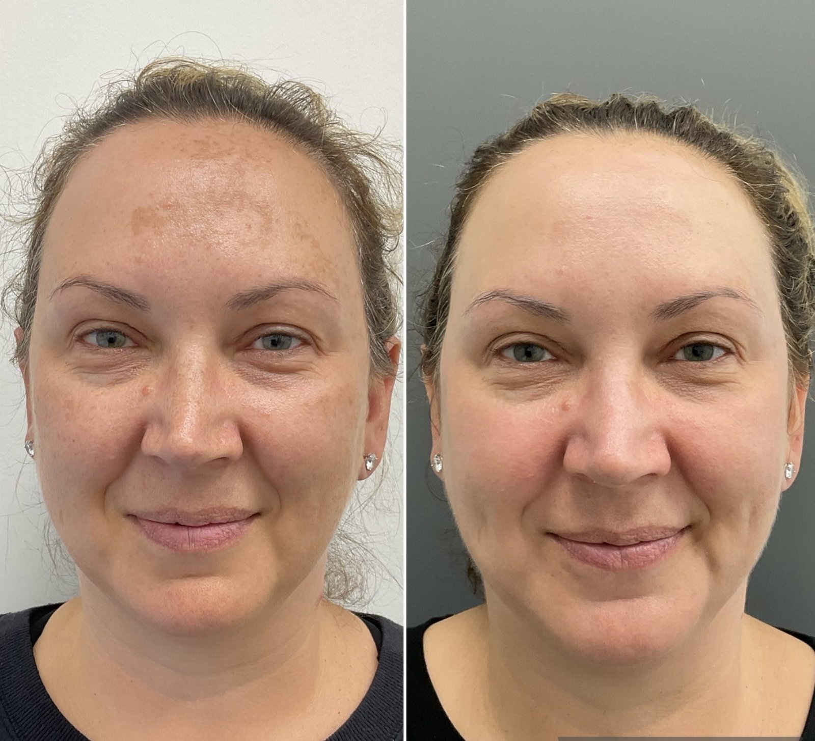 Before-and-after results from a Sciton HALO treatment by Nurse Jacklyn for melasma