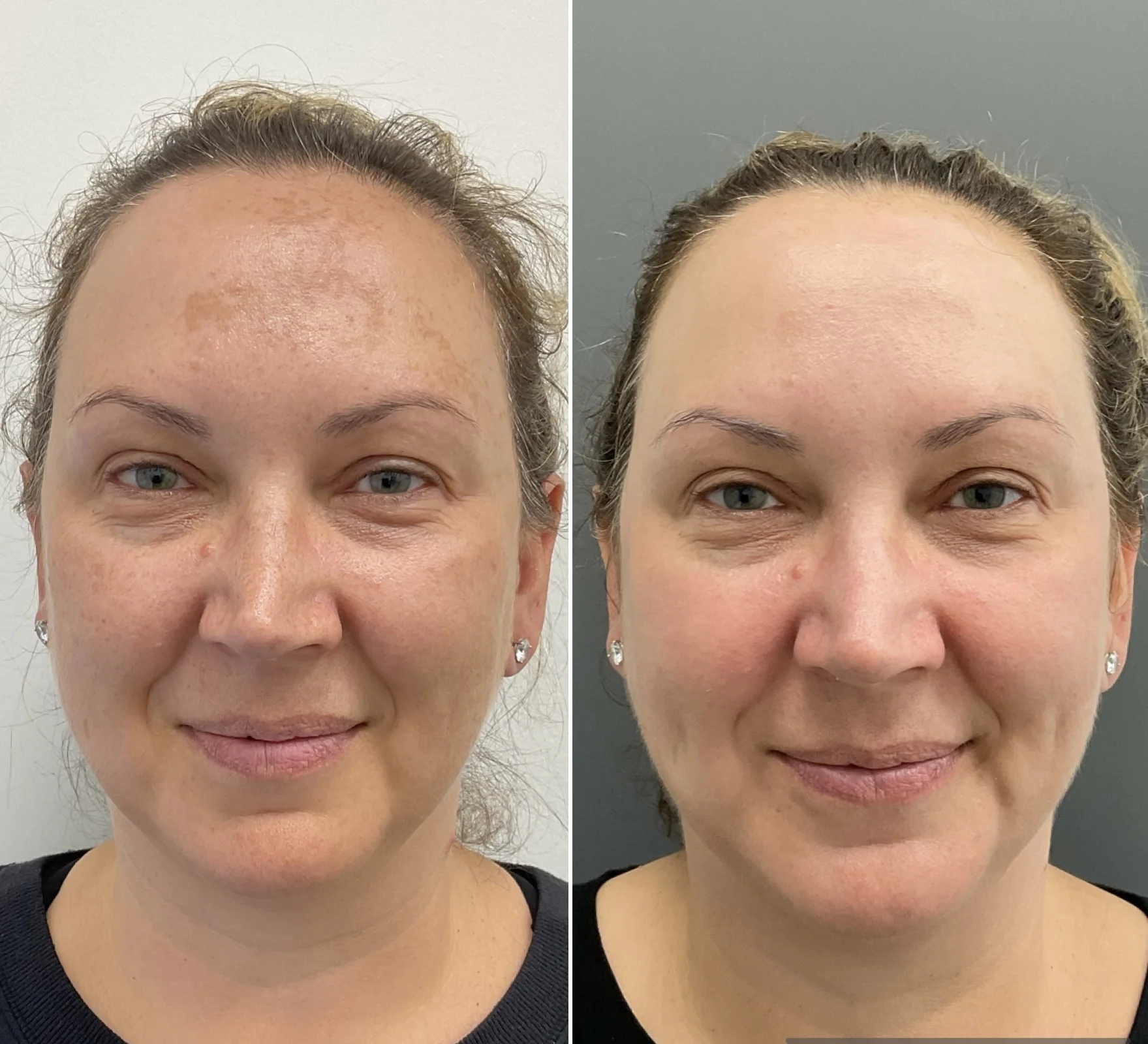 Before-and-after results from a Sciton HALO treatment by Nurse Jacklyn for melasma