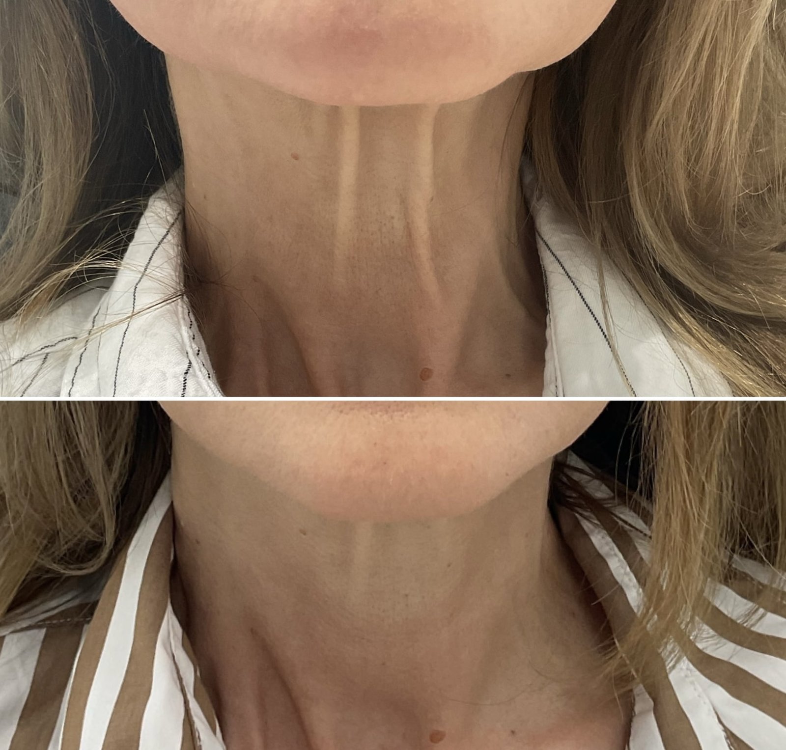 Botox Neck Treatment by Nurse Jacklyn