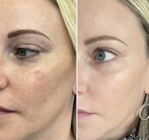 Before and After of BBL by Nurse Jacklyn for Sun Damage