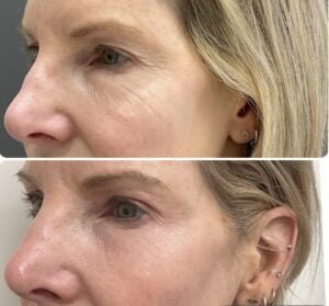 Before-and-after results from a Sciton Contour TRL Laser Resurfacing treatment show a reduction in wrinkles around the eyes and a reduction in pore size.
