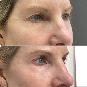 Before-and-after results from a Sciton Contour TRL Laser Resurfacing treatment show a reduction in wrinkles around the eyes and a reduction in pore size.