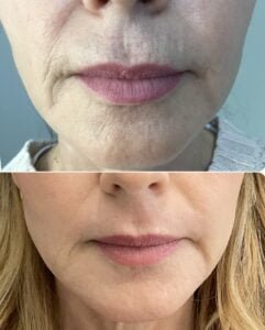 Before and after results from a Laser Resurfacing treatment by Nurse Jacklyn showing a reduction in fine lines and pore size