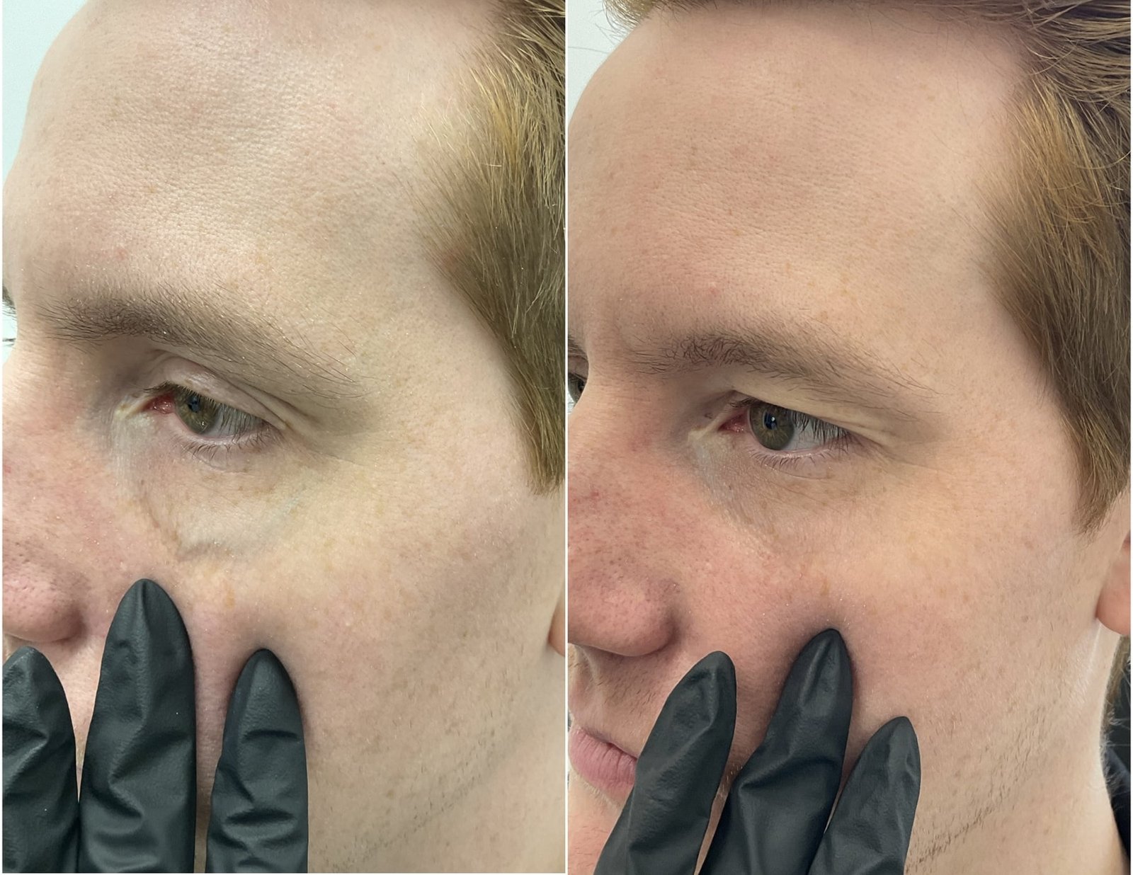 Periorbital Veins Before and After