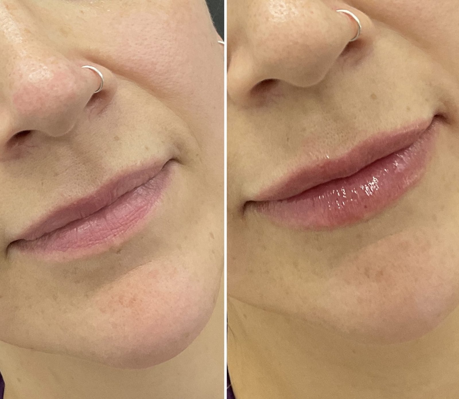 Before and after of natural looking lip filler by Nurse Jacklyn