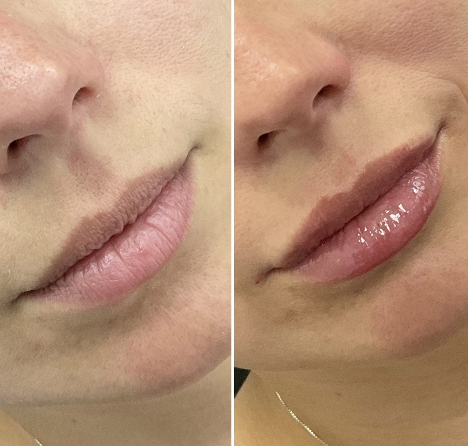 Before and after of natural looking lip filler by Nurse Jacklyn