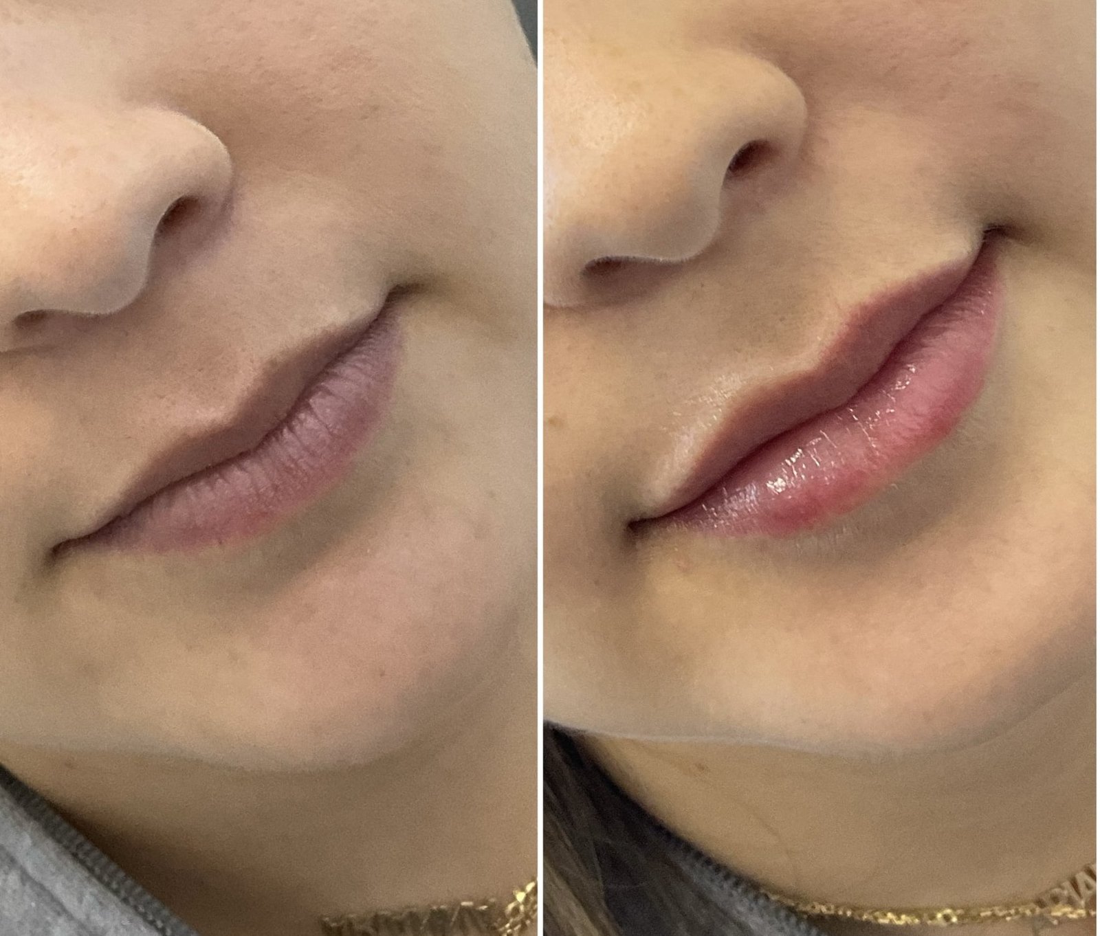 Before and after of natural looking lip filler by Nurse Jacklyn