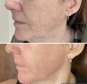 Before-and-after results from a Sciton Contour TRL Laser Resurfacing treatment by Nurse Jacklyn shows a reduction in wrinkles