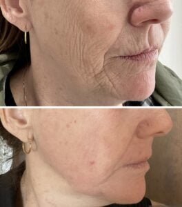 Before-and-after results from a Sciton Contour TRL Laser Resurfacing treatment by Nurse Jacklyn shows a reduction in wrinkles