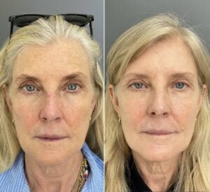 Before-and-after results from a Sciton HALO treatment by Nurse Jacklyn showing a reduction in sun damage and brown spots