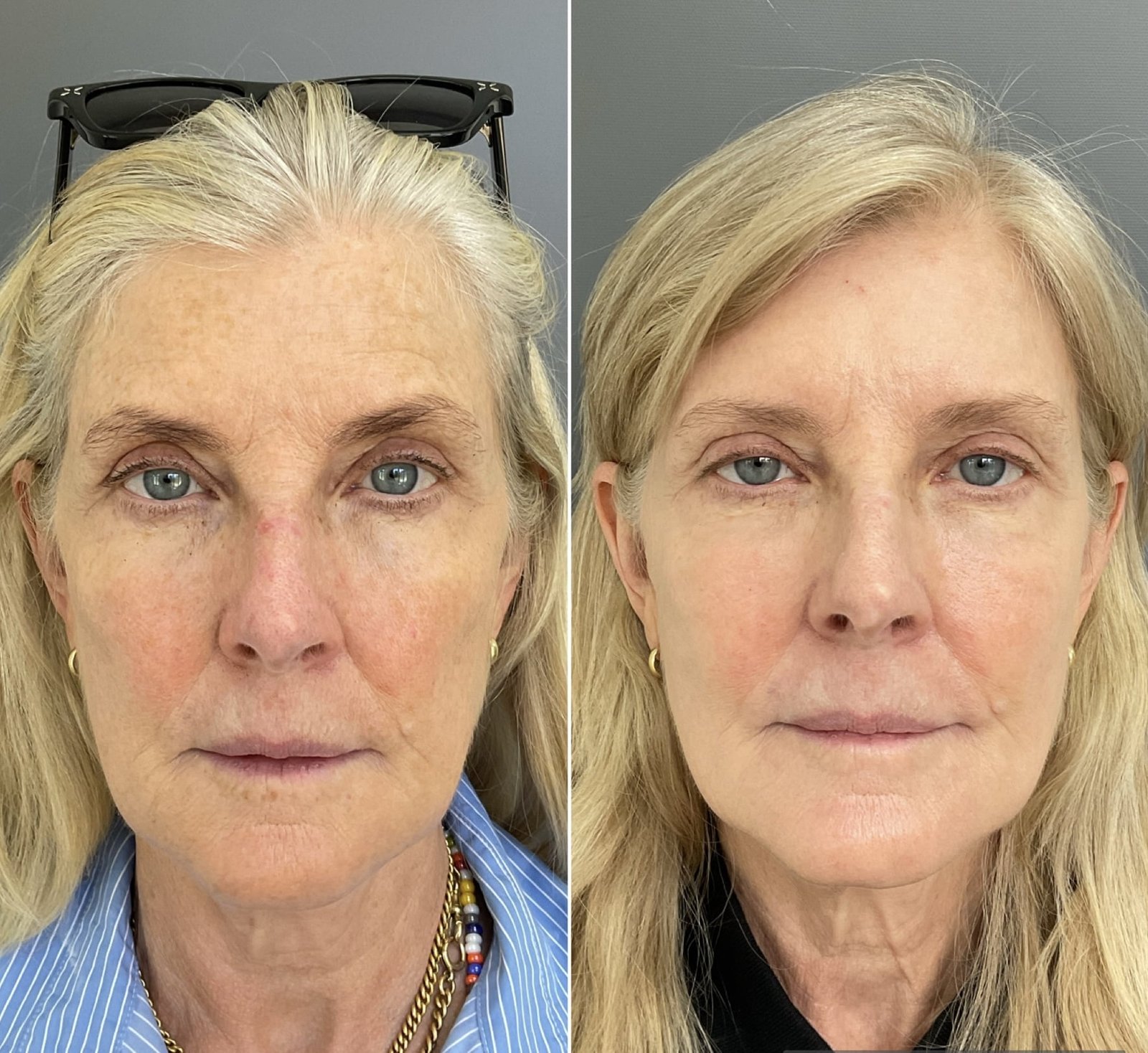 Before-and-after results from a Sciton HALO treatment by Nurse Jacklyn showing a reduction in sun damage and brown spots