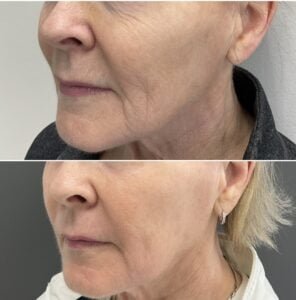 Before-and-after results from a Sciton Contour TRL Laser Resurfacing treatment show a reduction in wrinkles around the eyes and a reduction in pore size.
