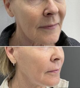Before-and-after results from a Sciton Contour TRL Laser Resurfacing treatment show a reduction in wrinkles around the eyes and a reduction in pore size.