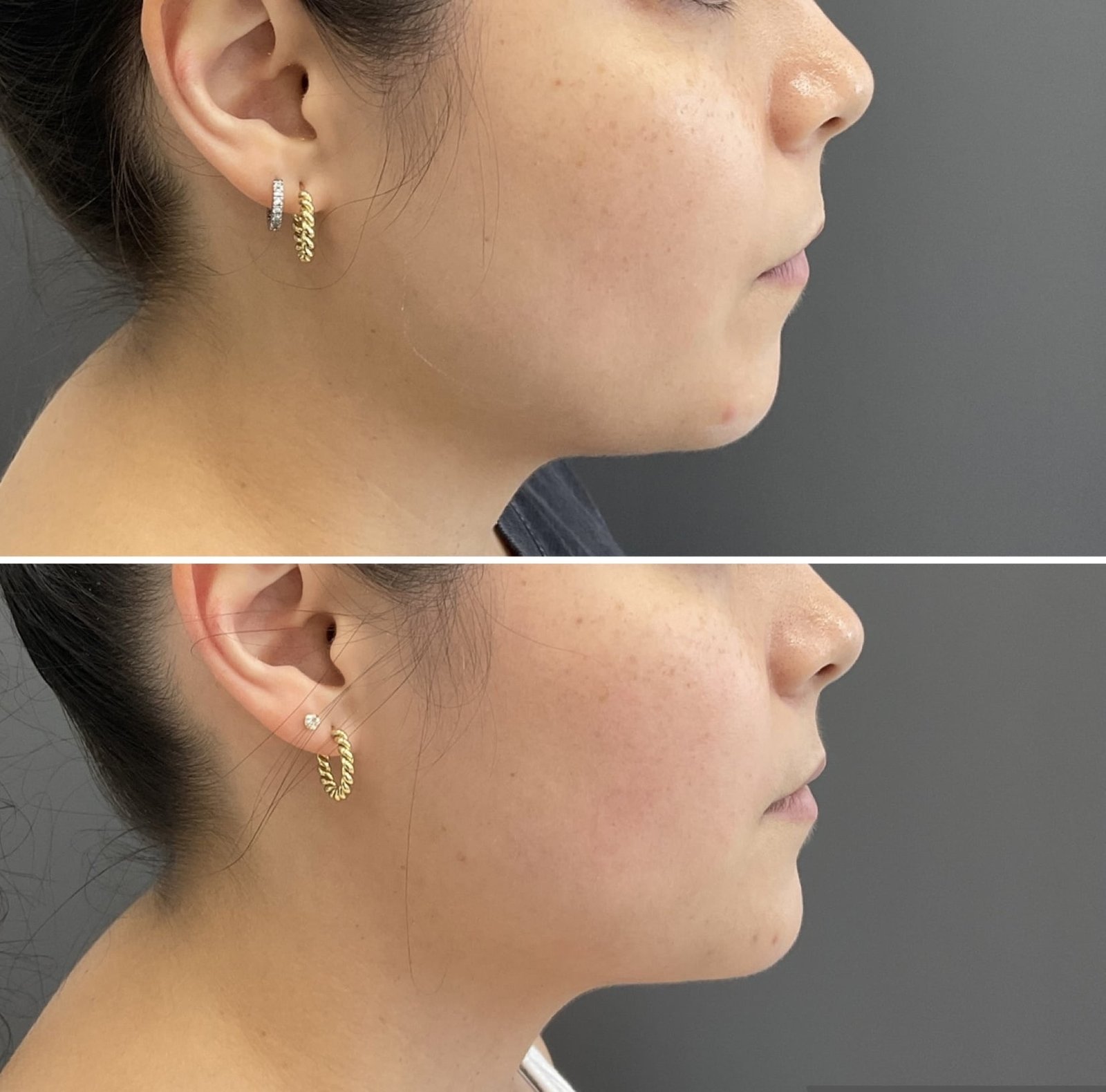 Before & After of Chin Filler treatment by Nurse Jacklyn that improved the client's jawline contour