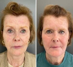 Before and After Results from an Ablative Laser Resurfacing with Sciton's Contour TRL, performed by Nurse Jacklyn