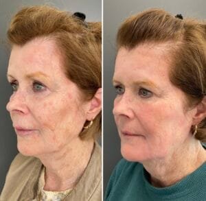 Before and After Results from an Ablative Laser Resurfacing with Sciton's Contour TRL, performed by Nurse Jacklyn