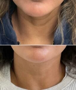 Morpheus RF microneedling and skin booster injections by Nurse Jacklyn for the neck reduced the appearance of necklace lines