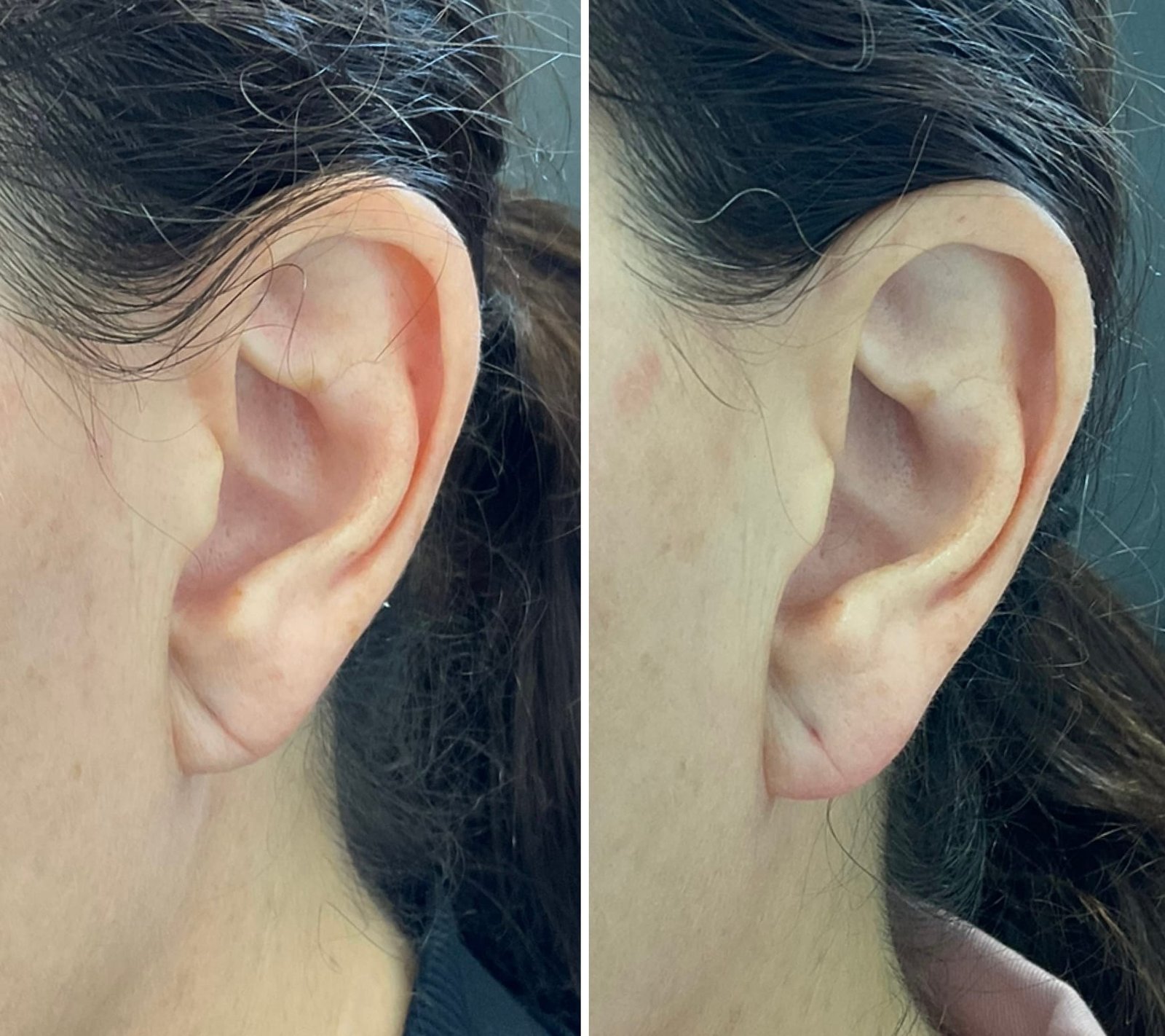Hyaluronic acid filler strategically placed in the ear lobe can support the weak structure and allow women to wear earrings comfortably again 
