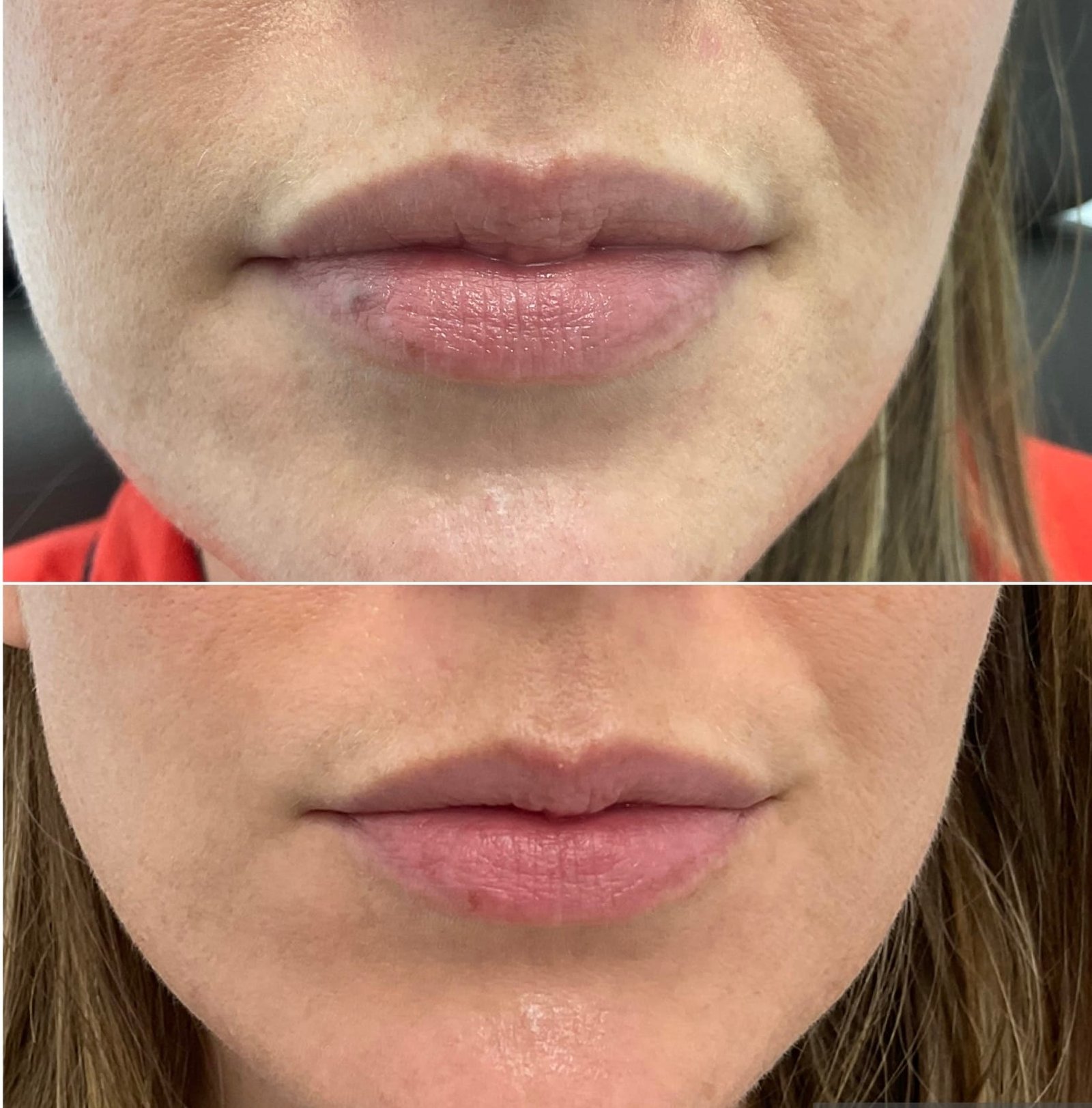 Venous lake before and after results following treatment with the ClearV by Sciton