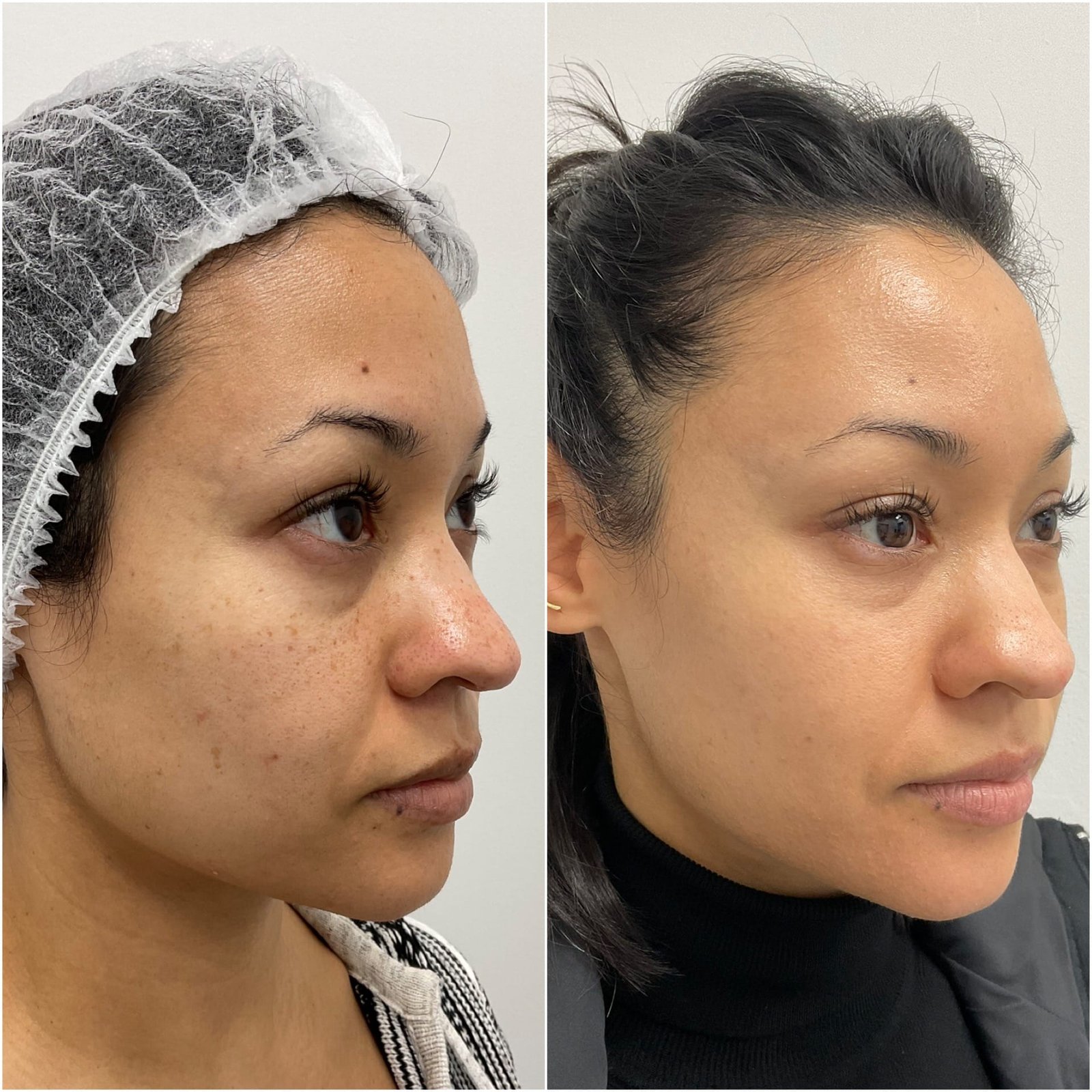 Side-by-side comparison showing the remarkable skin transformation two weeks after a combination BBL and HALO treatment by Nurse Jacklyn, highlighting improved tone, texture, and radiance.