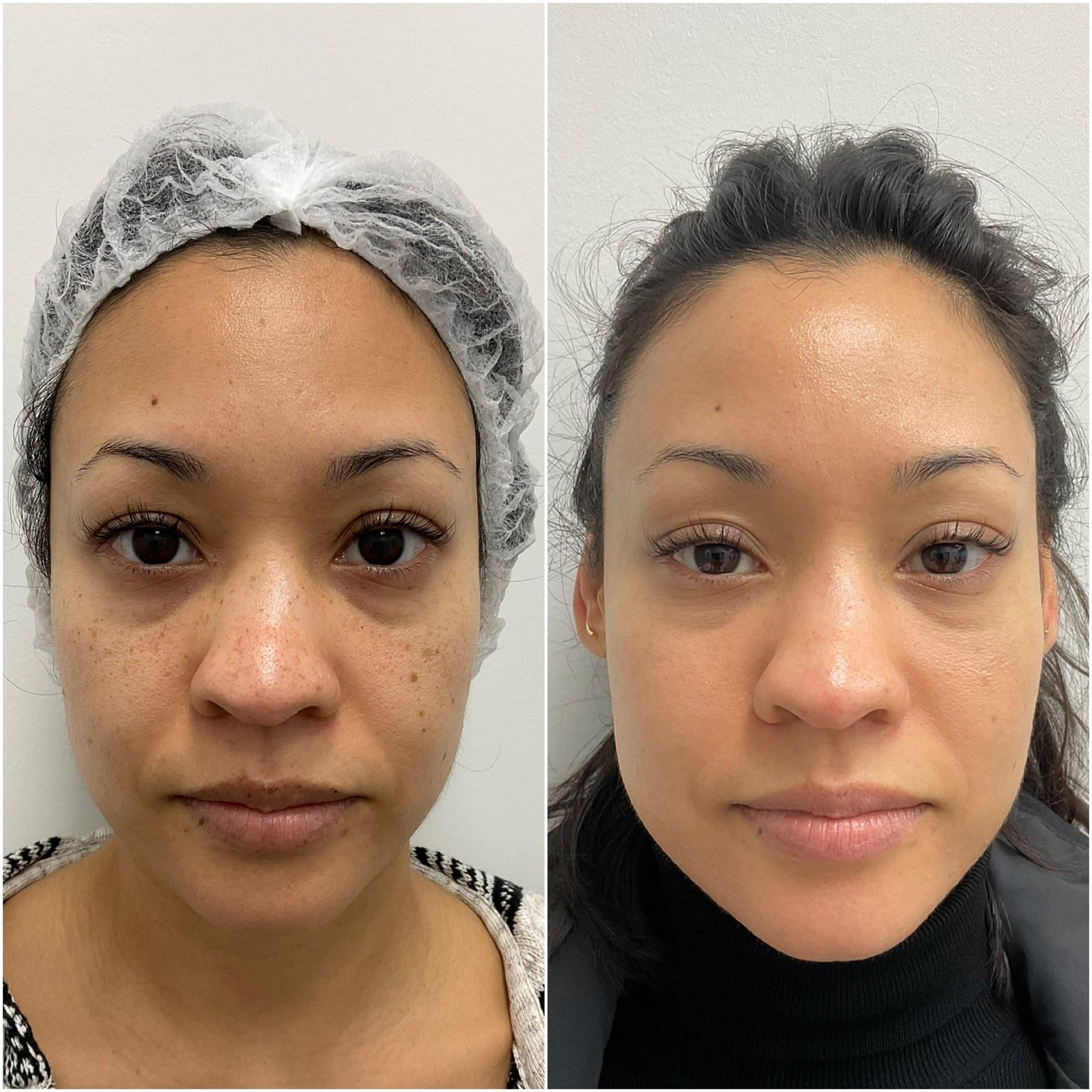 Side-by-side comparison showing the remarkable skin transformation two weeks after a combination BBL and HALO treatment by Nurse Jacklyn, highlighting improved tone, texture, and radiance.